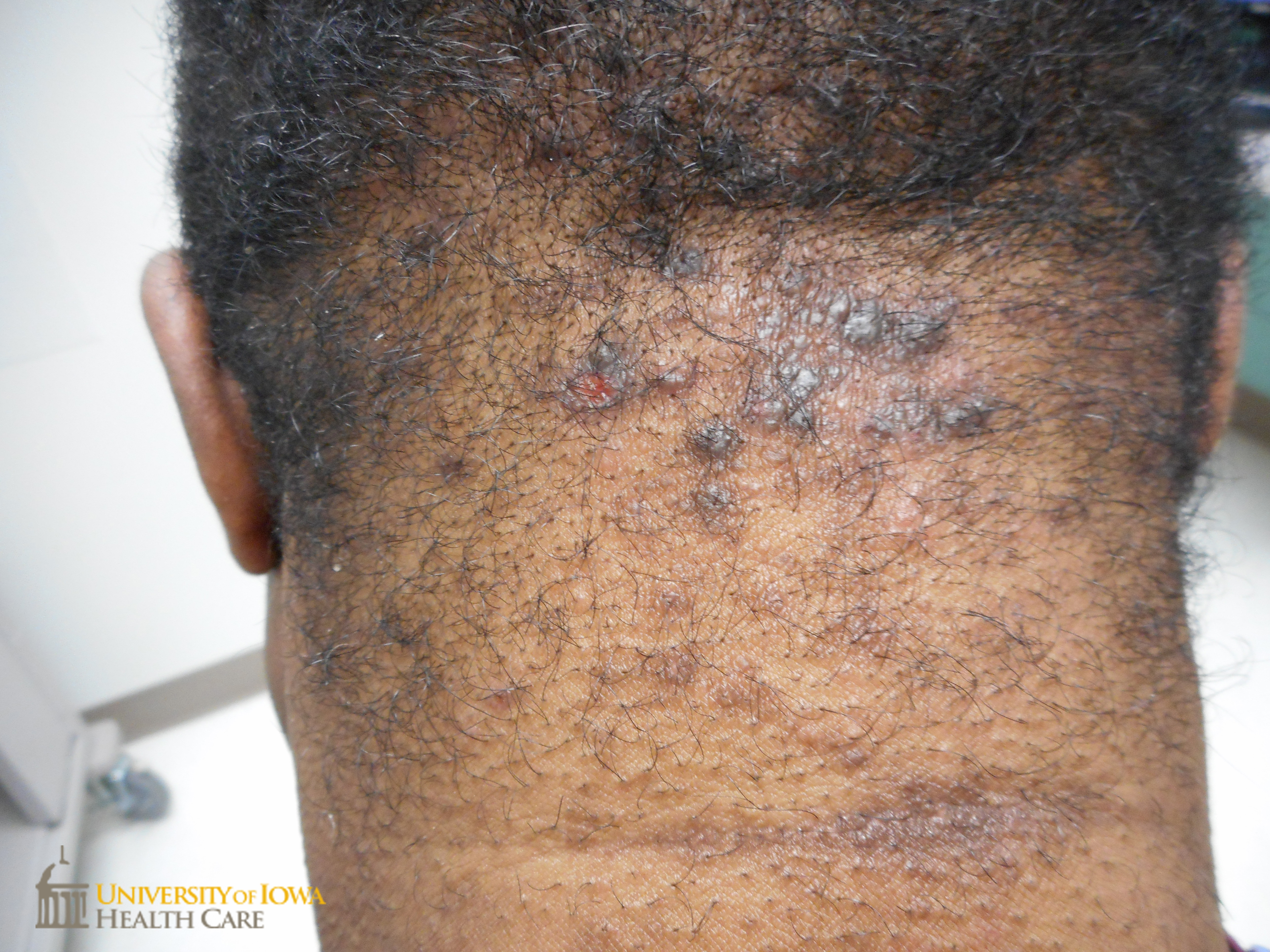 Hyperpigmented papules on the occipital scalp. (click images for higher resolution).